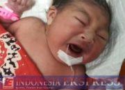 Bayi Baru Lahir Butuh Perhatian dan Uluran Tangan, Ada Kelainan di Kepala Sang Bayi